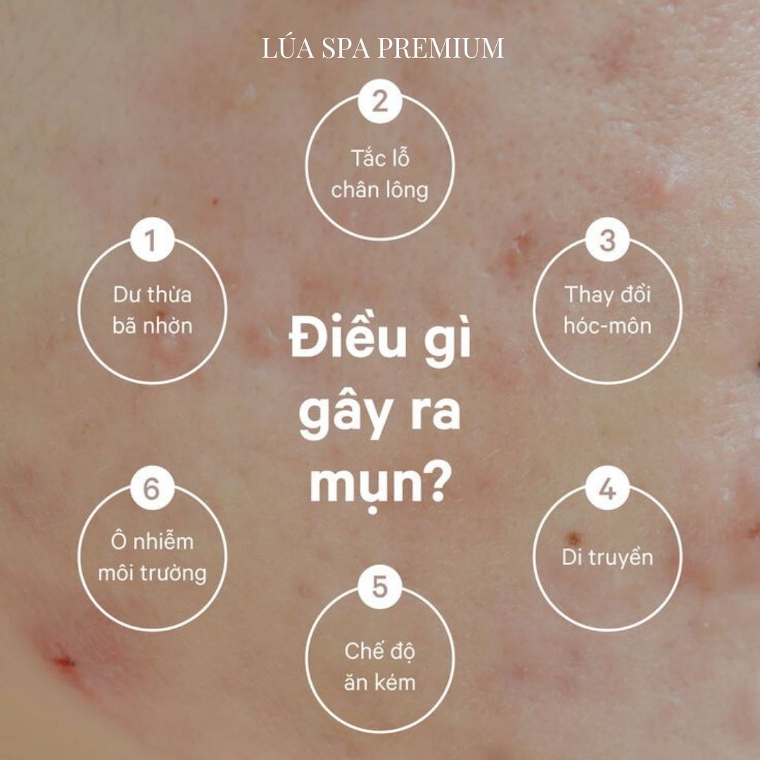 Trị mụn Kì diệu phương đông